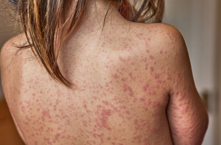 Vaccine Hesitancy Keeps Measles Alive as Europe Faces Ongoing Outbreak Risks